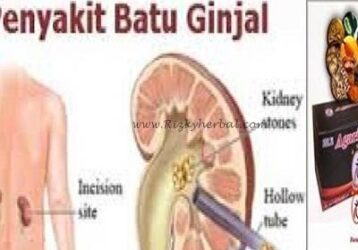 Obat Batu Ginjal Tanpa Operasi